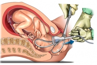 forcep
