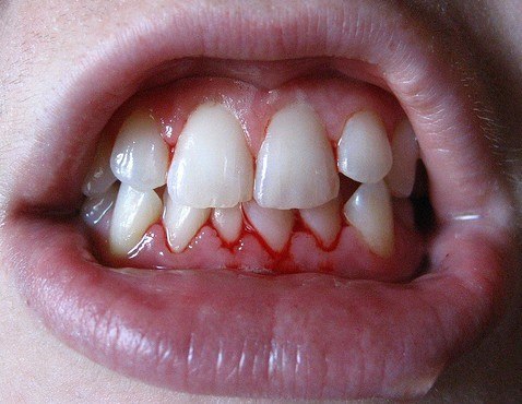 gingivitis