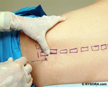 uploaded-regional_anesthesia-neuraxial_techniques-epidural-blockade-16b